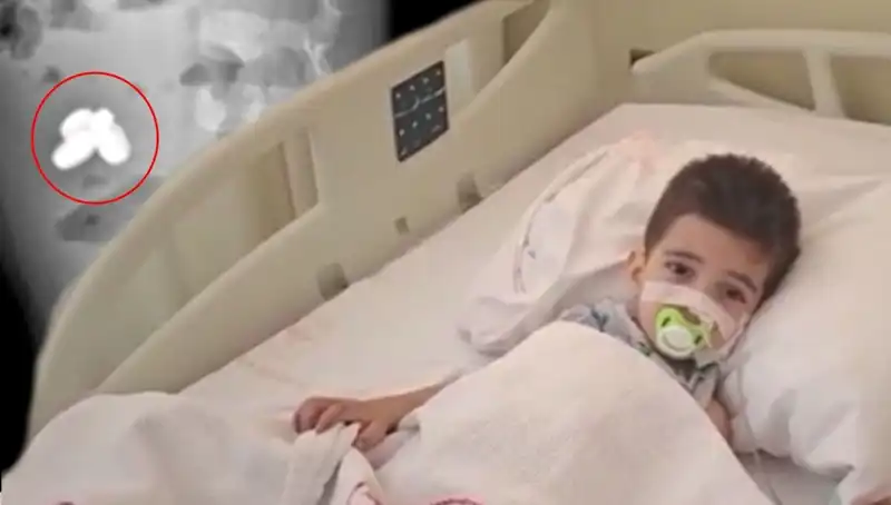 Pil ve Mıknatıs Yutan Çocuğun Hayatı Tehlikeye Girdi: Bağırsakları Yandı!